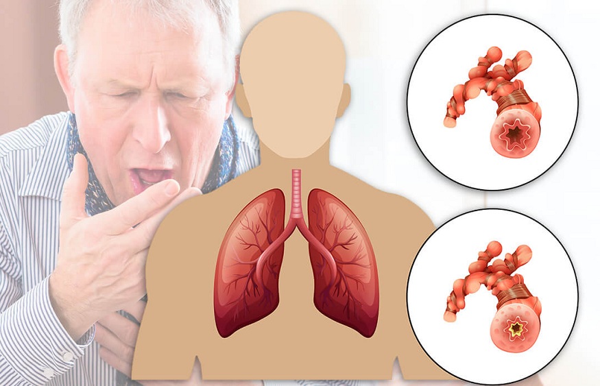 Understanding the Causes and Treatment of COPD